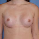 After Hormones, But Before Implants